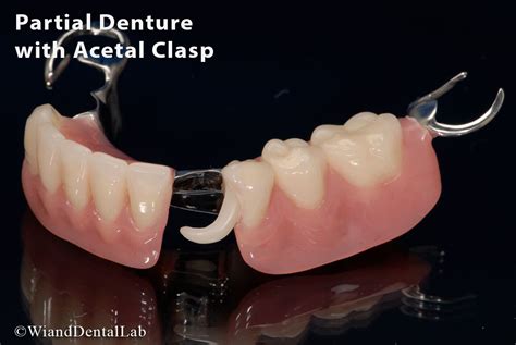 types of partial denture clasps.